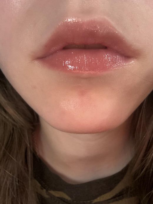 LipLift customer lip photo
