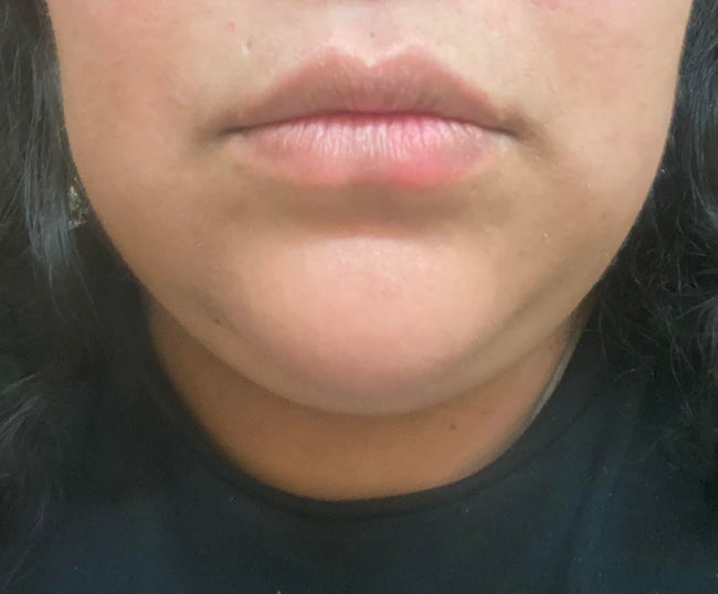Customer before LipLift gloss