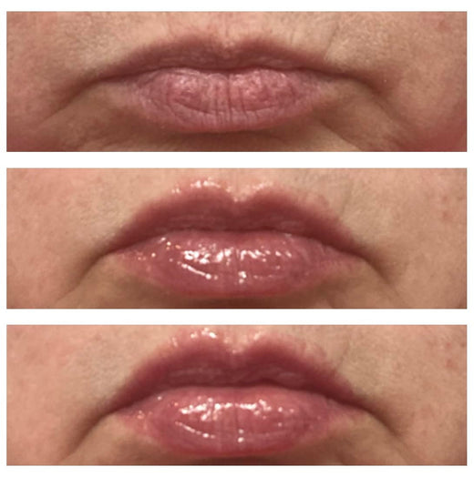 LipLift customer lip photo