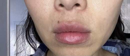 LipLift customer lip photo