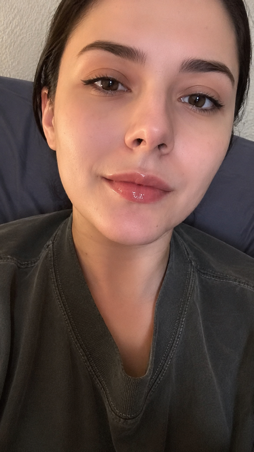 LipLift customer lip photo