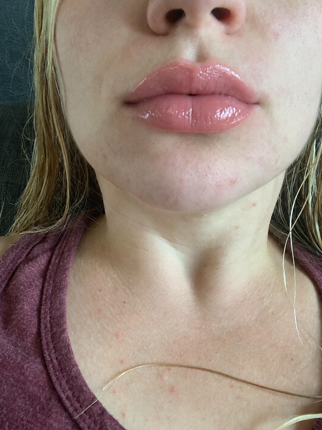 Customer after LipLift gloss