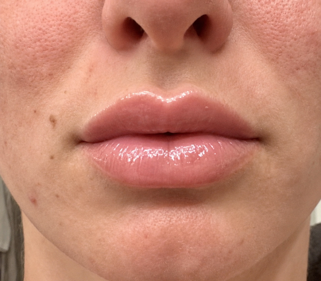 Customer after LipLift gloss