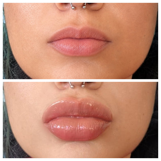 LipLift customer lip photo