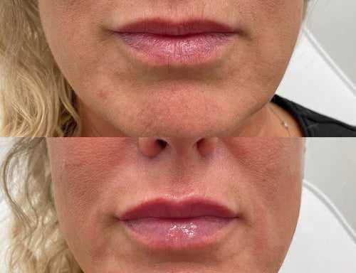 LipLift customer lip photo